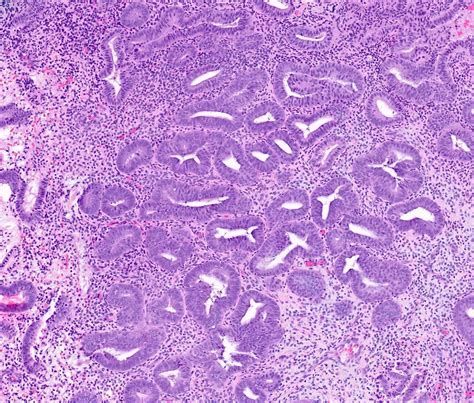 n Atypical epithelial hyperplasia is an. . Endometrial hyperplasia pathology outlines